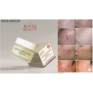Kem Chấm Mụn Acne Spot Dot Cream