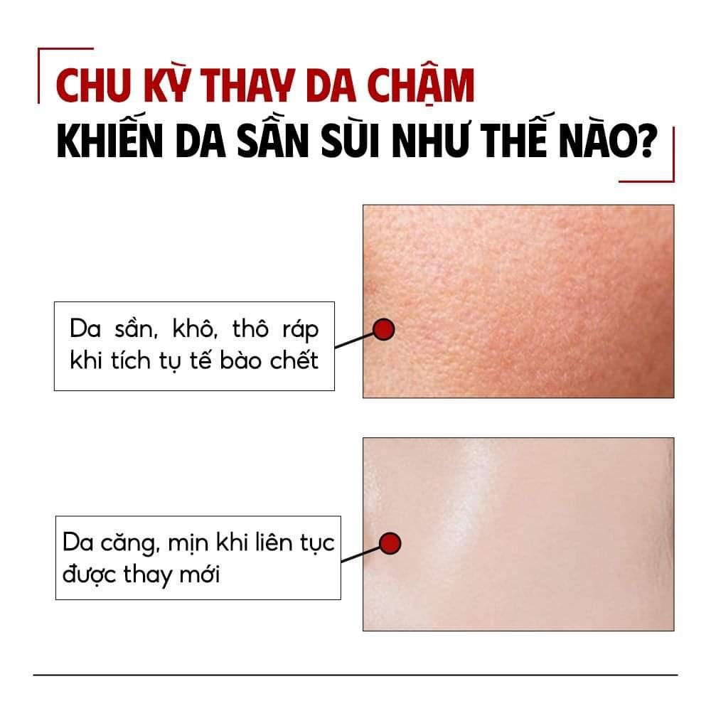 Serum So'Natural Red Peel Tingle Làm Giảm Mụn, Tái Tạo Làn Da 35ml