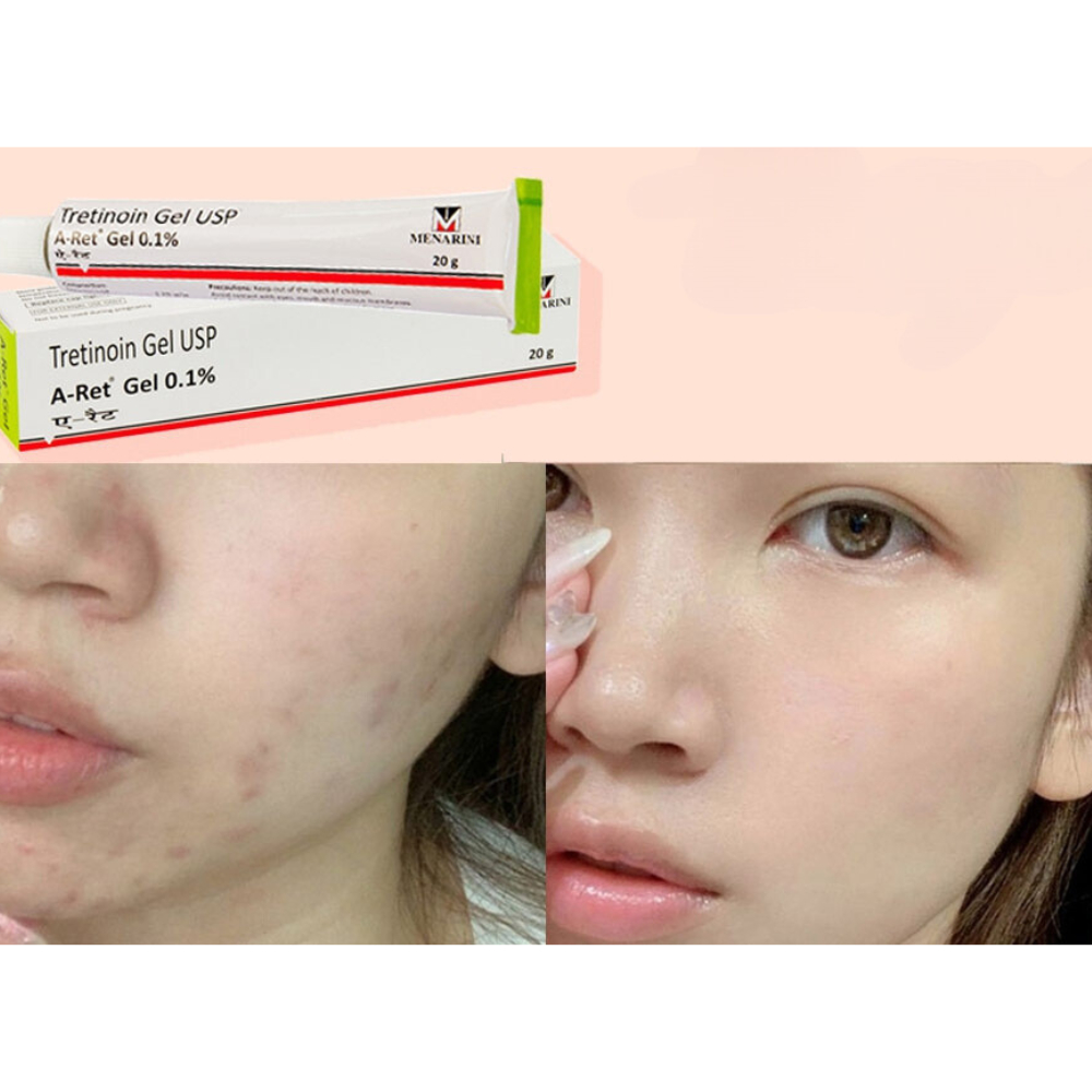 Tretinoin Aret Gel Ngăn Ngừa Lão Hóa 0.1 / 0.05 / 0.025, Giúp giảm mụn hiệu quả Tre Aret Ấn Độ Chính Hãng - UniPharma
