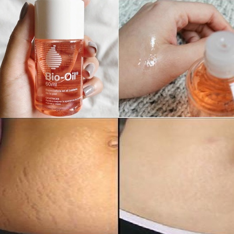 Tinh dầu Bio-Oil  (1 lọ)