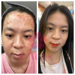 SERUM MỤN, Ngăn ngừa mụn
