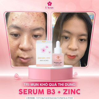 SERUM MỤN, Ngăn ngừa mụn