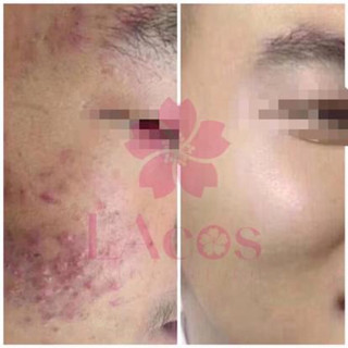 SERUM MỤN, Ngăn ngừa mụn