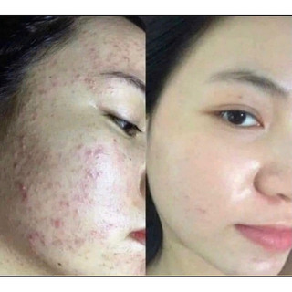 tinh chất chấm mụn tràm trà MH
