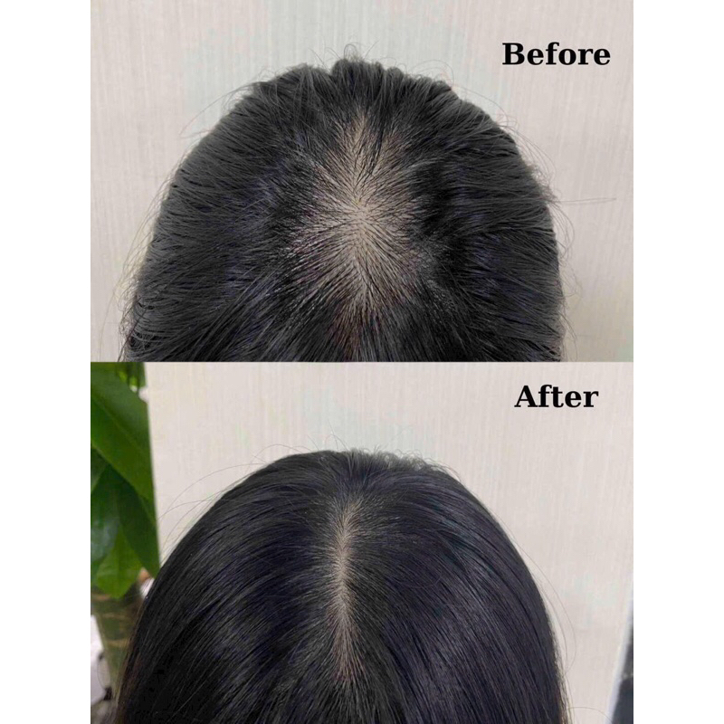 Combo KÍCH MỌC chuyên sâu HÓI RỤNG NẶNG