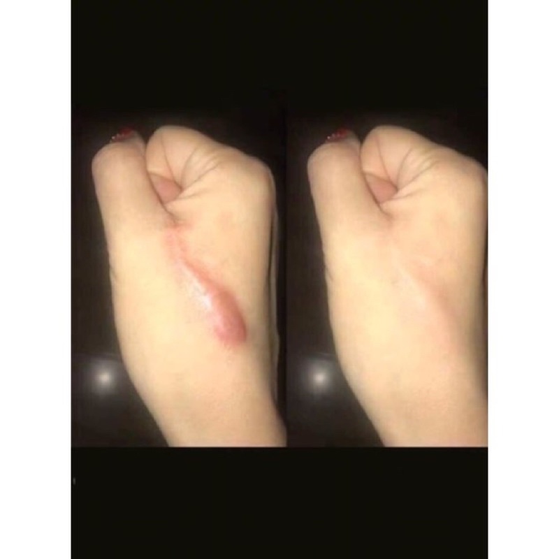 Nisanolona Tiên Tan Sẹo Lồi , Hàng Nhập Khẩu Ý