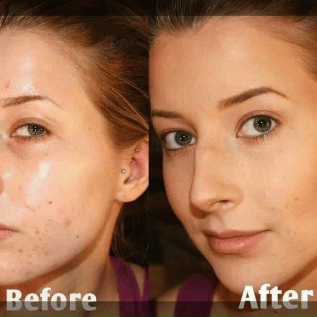 Gel Tái Tạo Trẻ Hóa Da Menarini Tretinoin Gel USP W/W - 20g