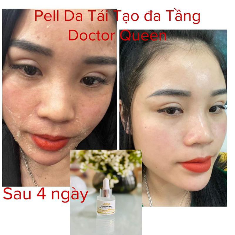 Peel nám đa tầng doctor queen