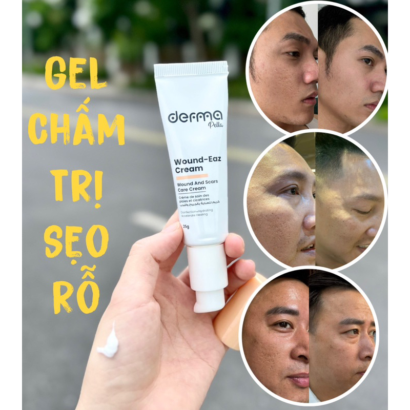 Gel Chấm Đ.ặc T.rị Sẹo Rỗ Derma Wound - Eaz