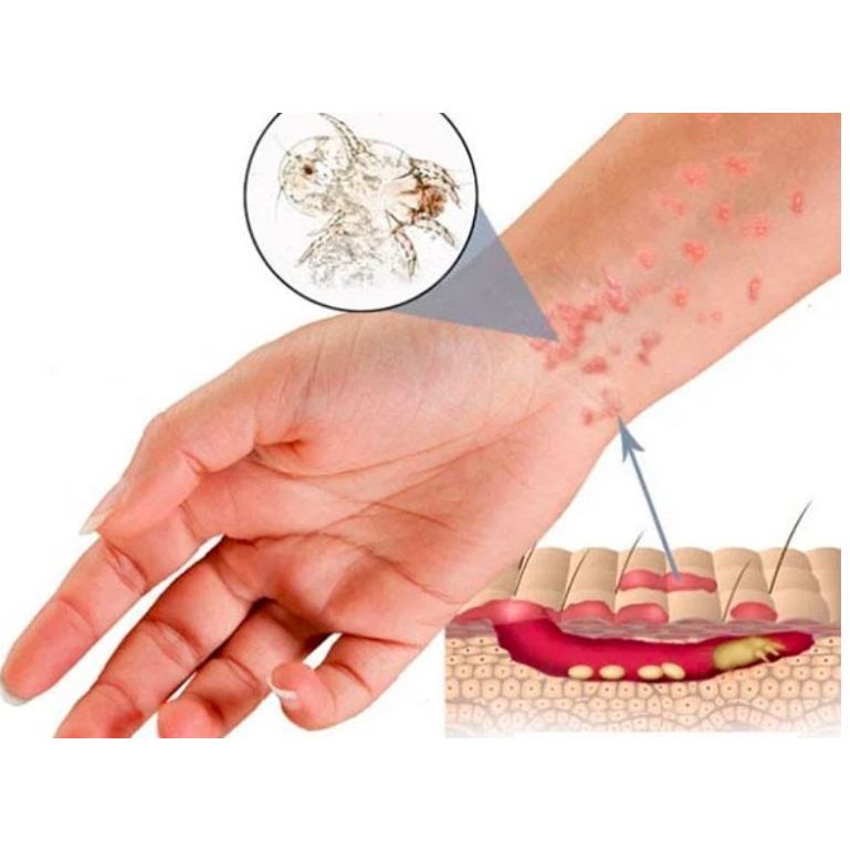 D.E.P mỡ bôi da giúp giảm ngứa do ghẻ, muỗi, côn trùng cắn lọ 10g