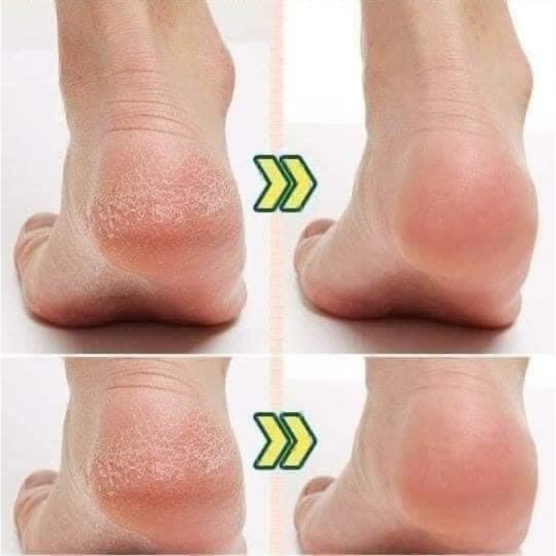 Combo 2 tuýp Kem Nứt Nẻ Gót Chân Kpem Nga 50ml Giúp Giảm Nẻ Chân,Tái Tạo Và Phục Hồi Da Gót Chân date 8/224