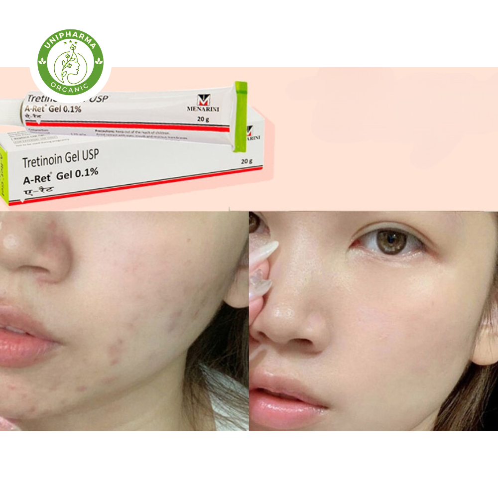 Tretinoin Aret Gel Ngăn Ngừa Lão Hóa 0.025 0.05 0.1, Giúp giảm mụn hiệu quả Tre Aret Ấn Độ Chính Hãng - UniPharma