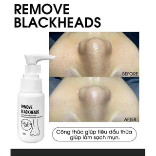 Ủ mụn đầu đen, mụn cám YOUNGER REMOVE BLACKHEADS
