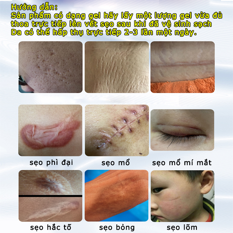 Kem mờ sẹo mờ thâm sẹo lồi sẹo lõm sẹo do mụn và giảm rạn da hiệu quả 20g nhanh chóng làm mờ sẹo lồi sẹo lõm