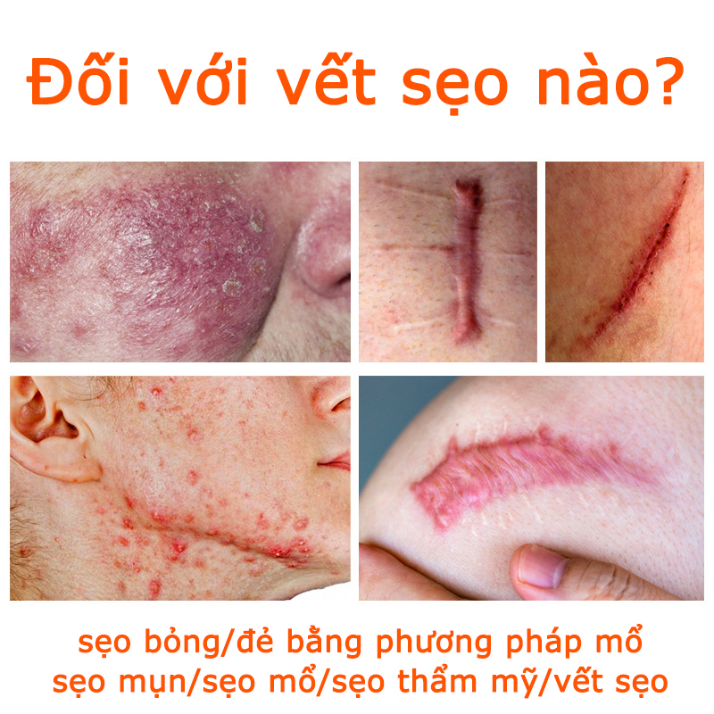 Kem mờ sẹo mờ thâm sẹo lồi sẹo lõm sẹo do mụn và giảm rạn da hiệu quả 20g nhanh chóng làm mờ sẹo lồi sẹo lõm