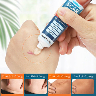 Kem mờ sẹo nga mờ sẹo thâm sẹo lồi sẹo lõm sẹo rỗ giảm mụn rạn da giảm thâm mắt