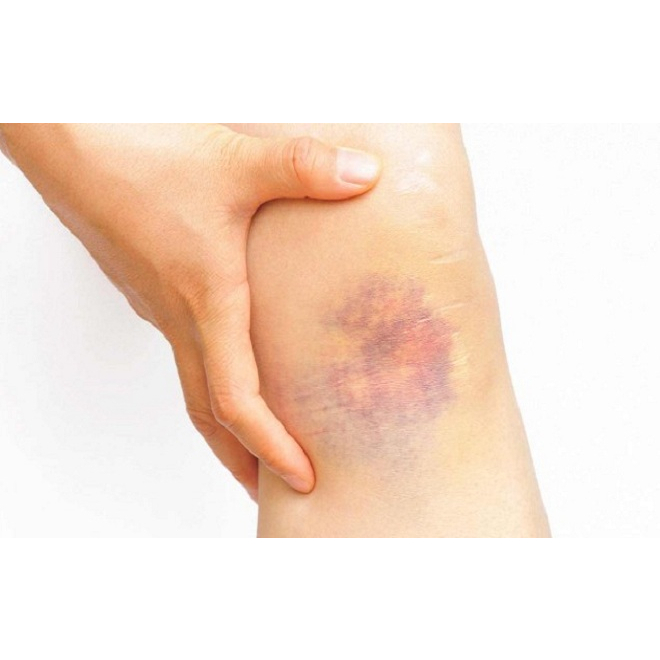 Kem bôi bầm tím Arnigel 45g