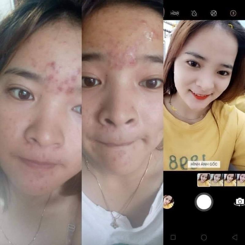 CAO MỤN THÂM ALMOMDS