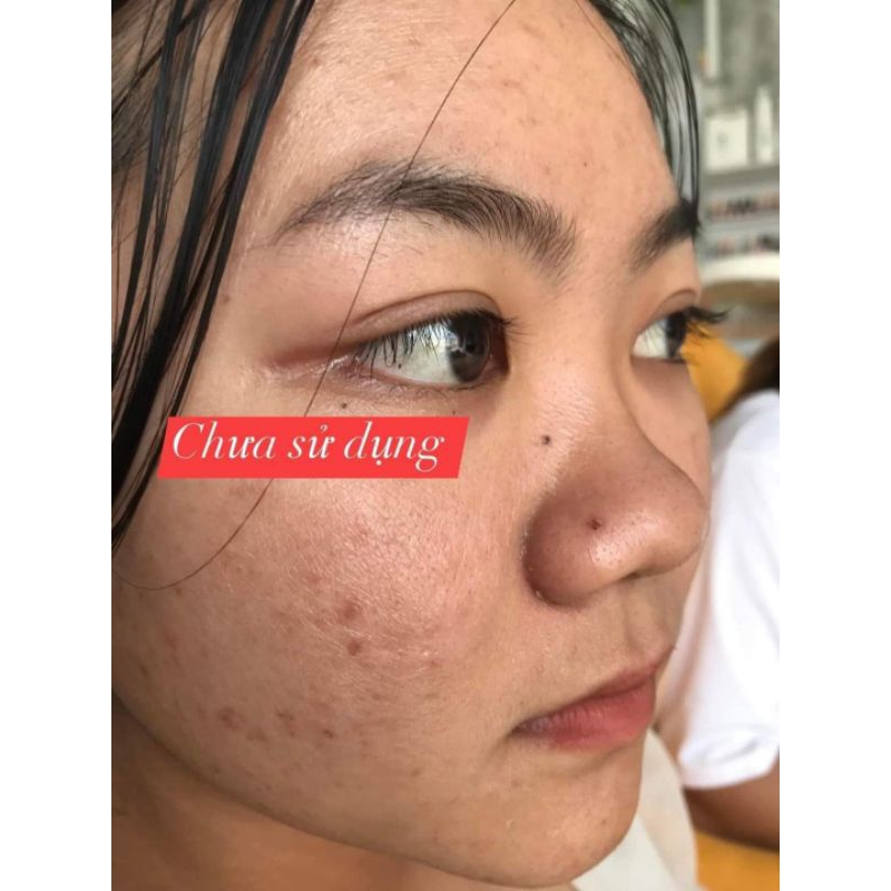 CAO MỤN THÂM ALMOMDS