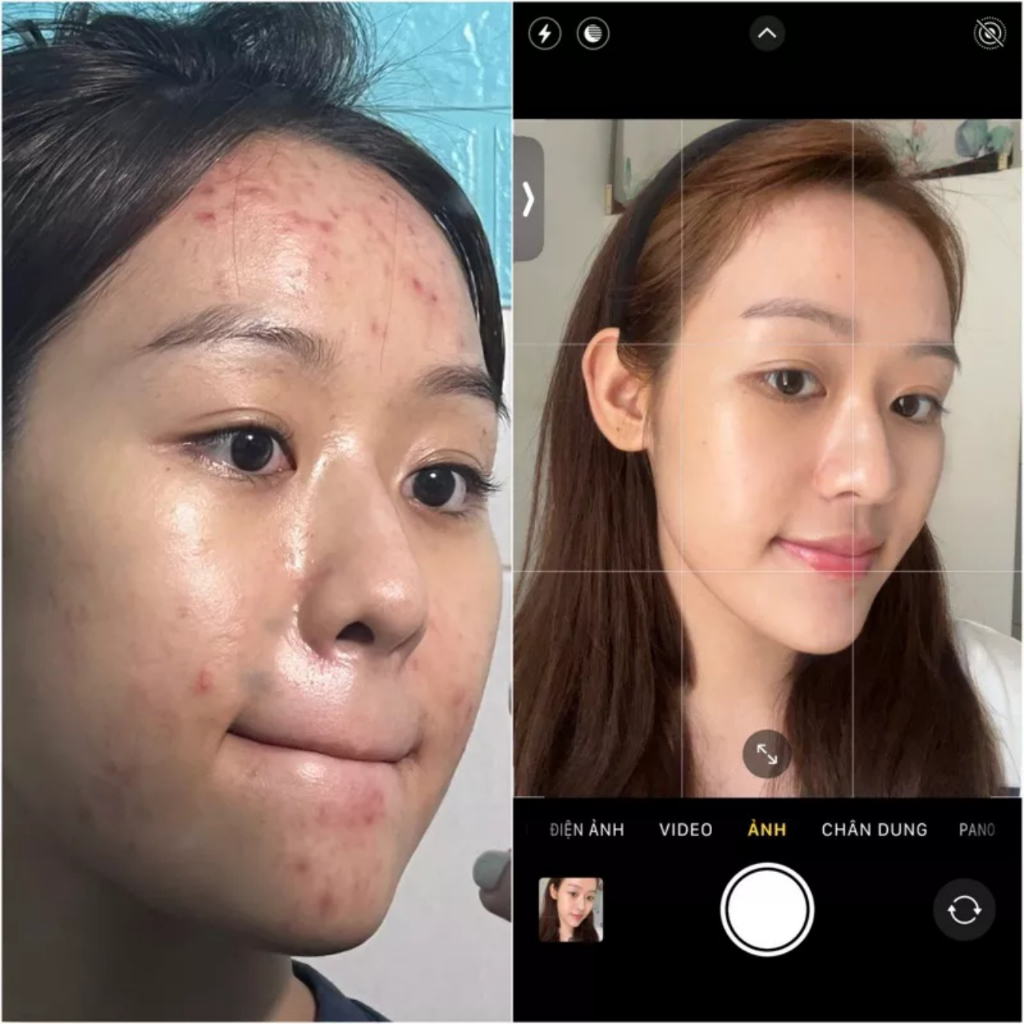 Serum Mụn Beskin Herbal  Giúp Sạch Mụn, Mờ Thâm Dưỡng Trắng Da Mặt 5ml
