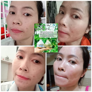 (TẶNG 4 NẠ CỪU ) COMBO PEEL DA COLLAGEN GALYLIN