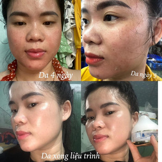 (TẶNG 4 NẠ CỪU ) COMBO PEEL DA COLLAGEN GALYLIN
