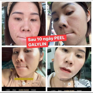 (TẶNG 4 NẠ CỪU ) COMBO PEEL DA COLLAGEN GALYLIN