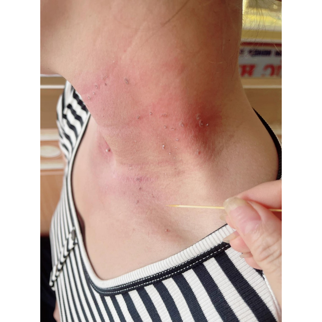 Chấm Xoá Nốt Ruồi, Tàn Nhang Mụn Cóc. Mụn Cơm Mụn Dư Mắc Cá Chân Collagen hũ 3ml