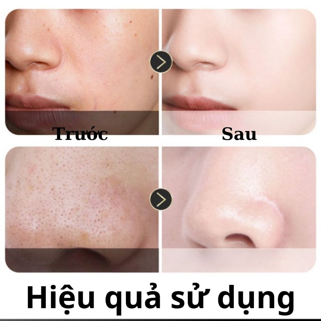 Mặt Nạ Sủi Bọt Than Tre Tấm Thị Làm Sạch Da Giảm Mụn Đầu Đen Và Bả Nhờn, Mặt Nạ Than Tre Giúp Sáng Da Mịn Màng