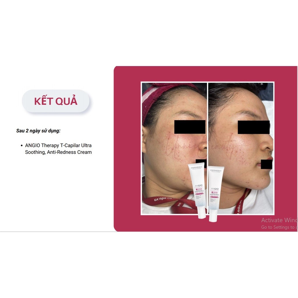 Kem Dưỡng Dành Cho Da Nhạy Cảm/Lộ Mao Mạch Dermedic Redness