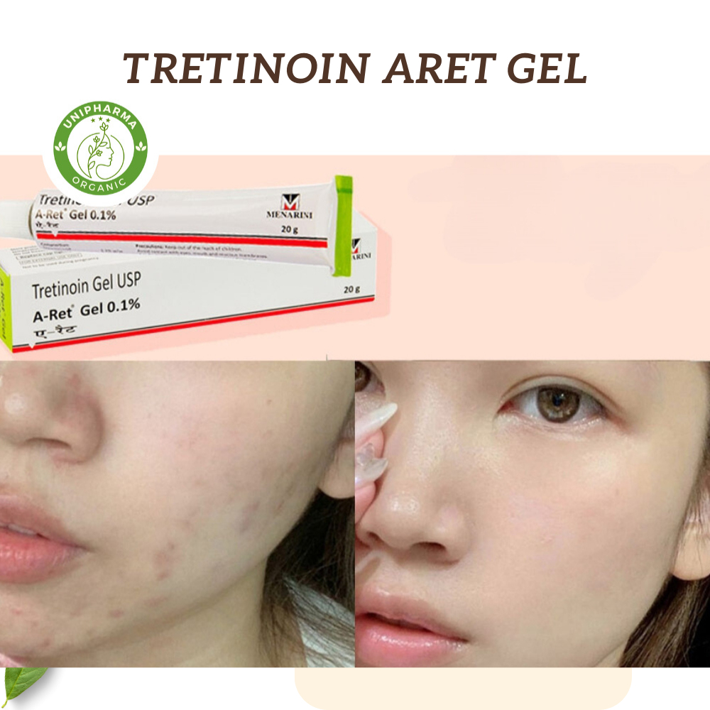 Gel mụn Tretinoin Aret Ấn Độ giúp giảm mụn, mờ thâm, nám, chống lão hóa và căng bóng da mặt - Unipharma - 20g