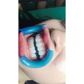 sứ  làm răng chamsima BL đức