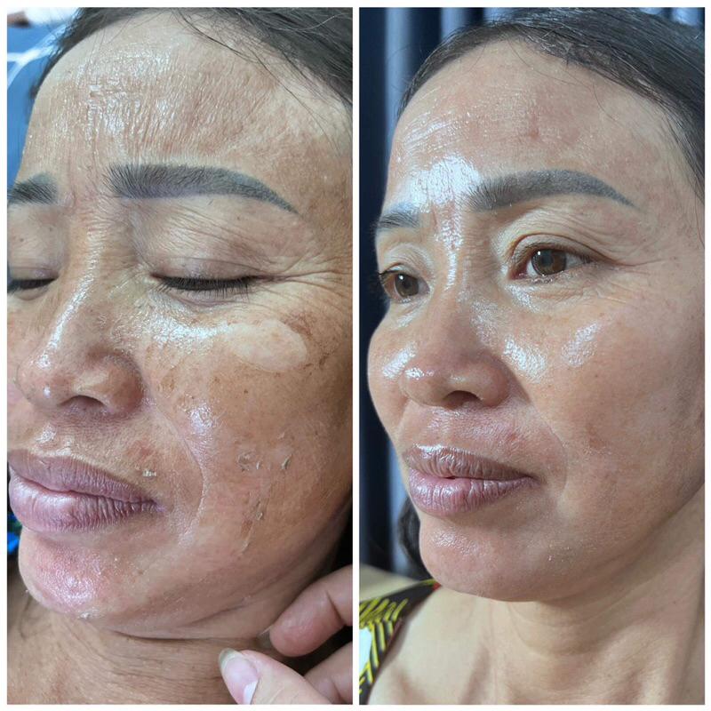 Peel bóc tách nám đông trùng giúp sạch nám trắng da và căng bóng