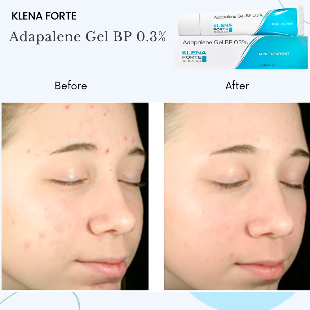Gel Giảm Mụn Klena Forte, Adapalene gel 0,3% giúp giảm mụn, mờ thâm, dưỡng ẩm và ngăn ngừa lão hóa 15g