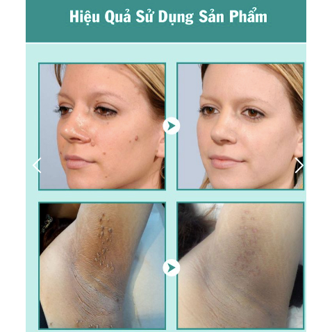 Kem rụng mụn thịt dư KEYOU - KEYOU kem bôi bật gốc cồi mụn thịt dư, nốt ve chó, u mềm treo 20g