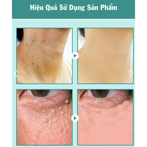 Kem rụng mụn thịt dư KEYOU - KEYOU kem bôi bật gốc cồi mụn thịt dư, nốt ve chó, u mềm treo 20g