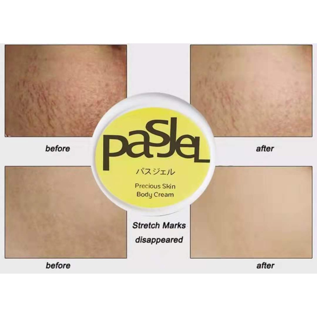 Kem xóa vết rạn da chống nhăn Vết sẹo chống lão hóa cho phụ nữ  Trẻ hóa làn da Xóa sẹo khi mang thai Chăm sóc cơ thể 50g