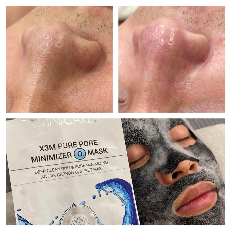 Mask sủi O2 nhà CliniCare