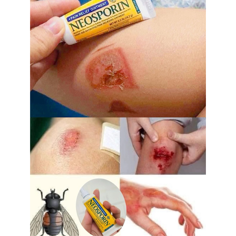 Neosporin lành vết thương hở, vết bỏng vết cắn Neosporin Pain Relief Ointment 56.7g Mỹ Date Mới Nhất