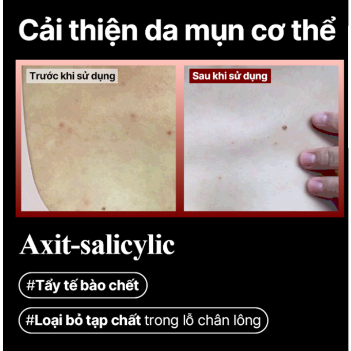 Sữa tắm cho da mụn RED ACNE BODY WASH 400ml