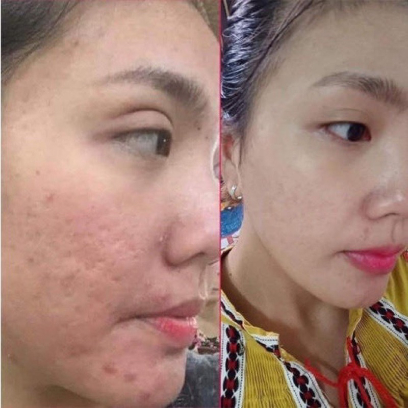 Kem xóa sẹo lồi, sẹo thâm, sẹo lâu năm, sẹo phẫu thuật, gel strataderm Thụy Sĩ