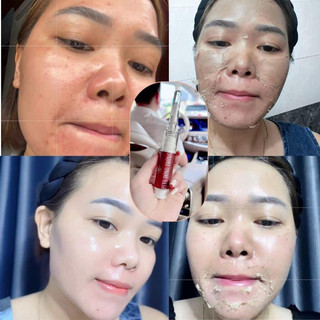 Peel da Đông Trùng Huyền Phi