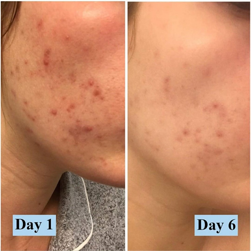 Sữa Rửa Mặt Tạo Bọt PanOxyl Acne Foaming Wash Benzoyl Peroxide