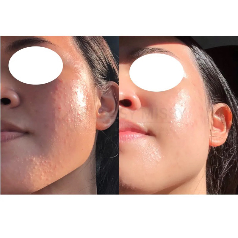 Sữa Rửa Mặt Tạo Bọt PanOxyl Acne Foaming Wash Benzoyl Peroxide