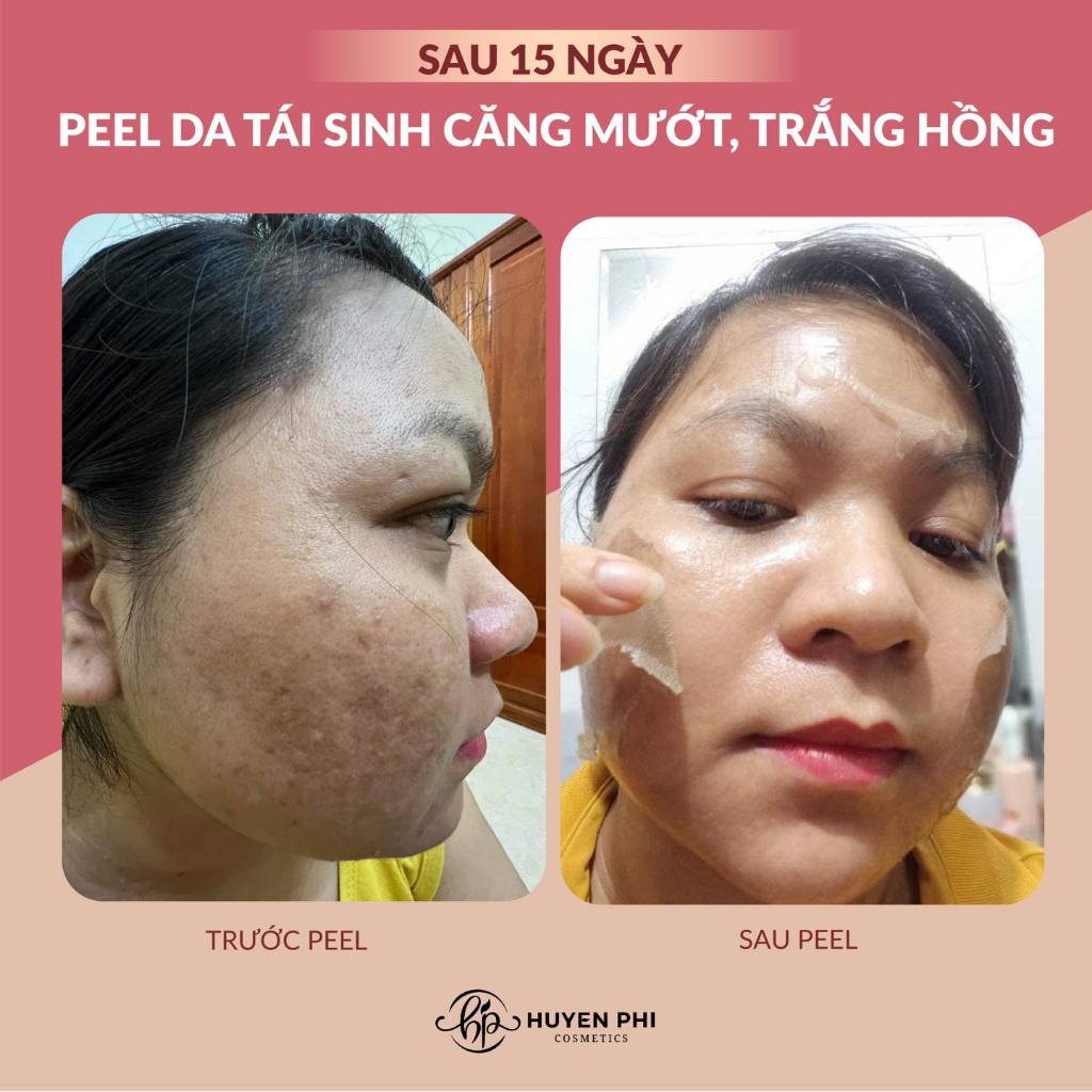 Peel Da Đông Trùng Tươi HUYỀN PHI Chính Hãng 10ml Bóc Tách Nám Tái Tạo Da Trắng Mịn Không Sưng Đỏ