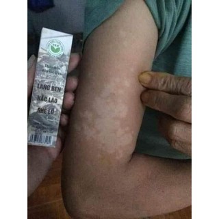 Thảo mộc bôi lang ben TKH