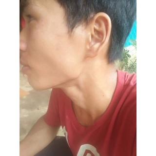 Thảo mộc bôi lang ben TKH