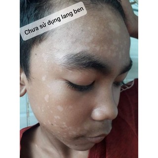 Thảo mộc bôi lang ben TKH