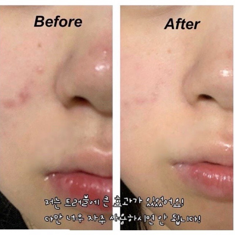 Miếng Lau Giảm Mụn Stridex, Toner Pad BHA Tẩy Tế Bào Cho Da Nhạy Cảm BHA 0.5% - 1% - 2%