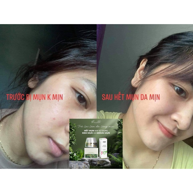 Combo Face Rau Má + Serum Mụn